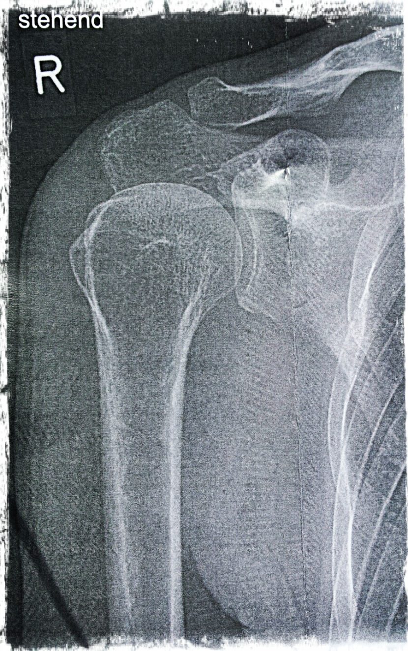Impingement-Syndrom Schulter - pelzblog